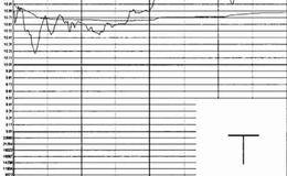 什么是“T”形K线？“T”形涨停板K线形态较多地出现在主力建仓或洗盘阶段